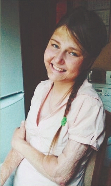 Девушки с ожогами предсказали проблемы Марины Хлебниковой после пожара